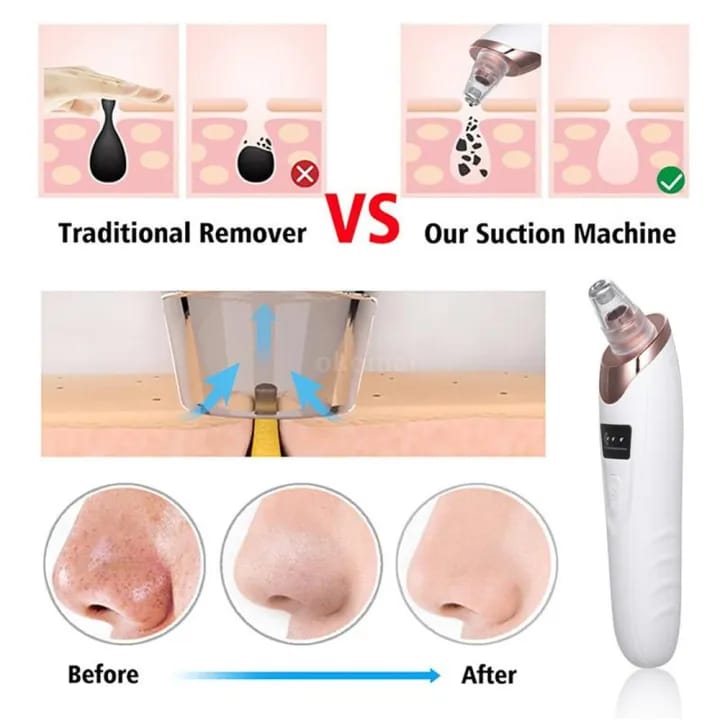 Blackhead removal machine